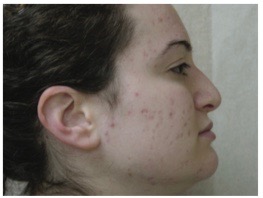 Acne Post Treatment